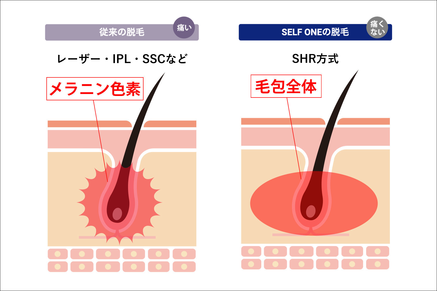 毛根の説明